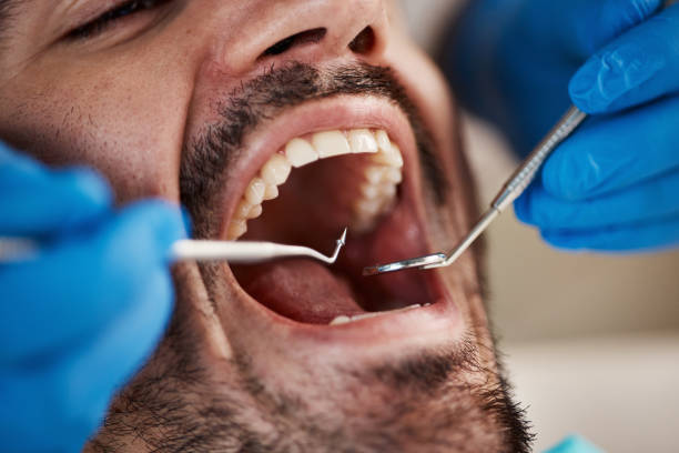 Best Emergency Dentist for Lost Fillings or Crowns in Gulf Hills, MS